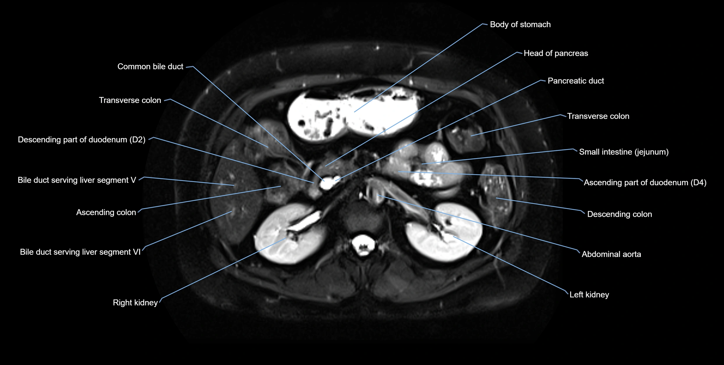 MRI MRCP axial cross sectional anatomy 3T radiology  image-img-10001-00026.webp